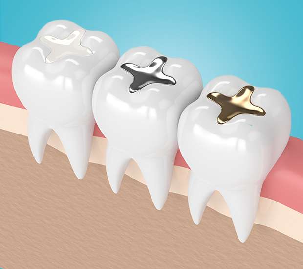 Las Vegas Composite Fillings