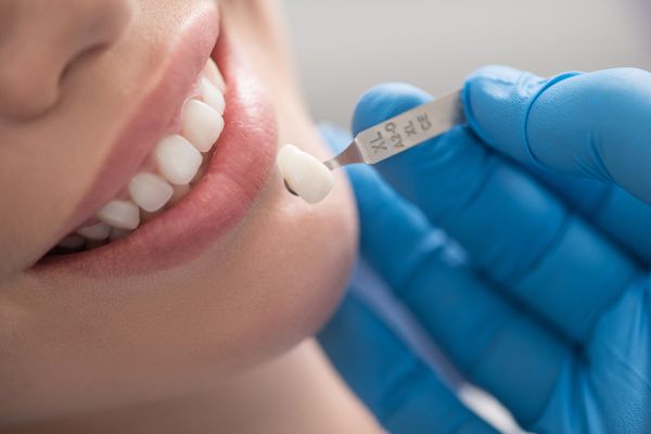 Porcelain Veneers Or Dental Crowns: What Do I Need?