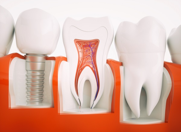 How Do I Know If I&# ;m A Candidate For Dental Implants?