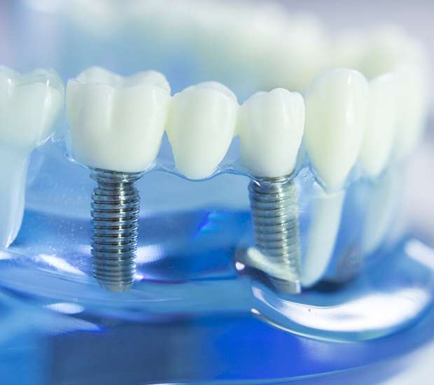 Las Vegas Dental Implants