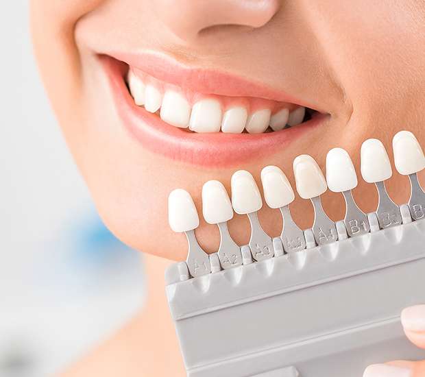 Las Vegas Dental Veneers and Dental Laminates